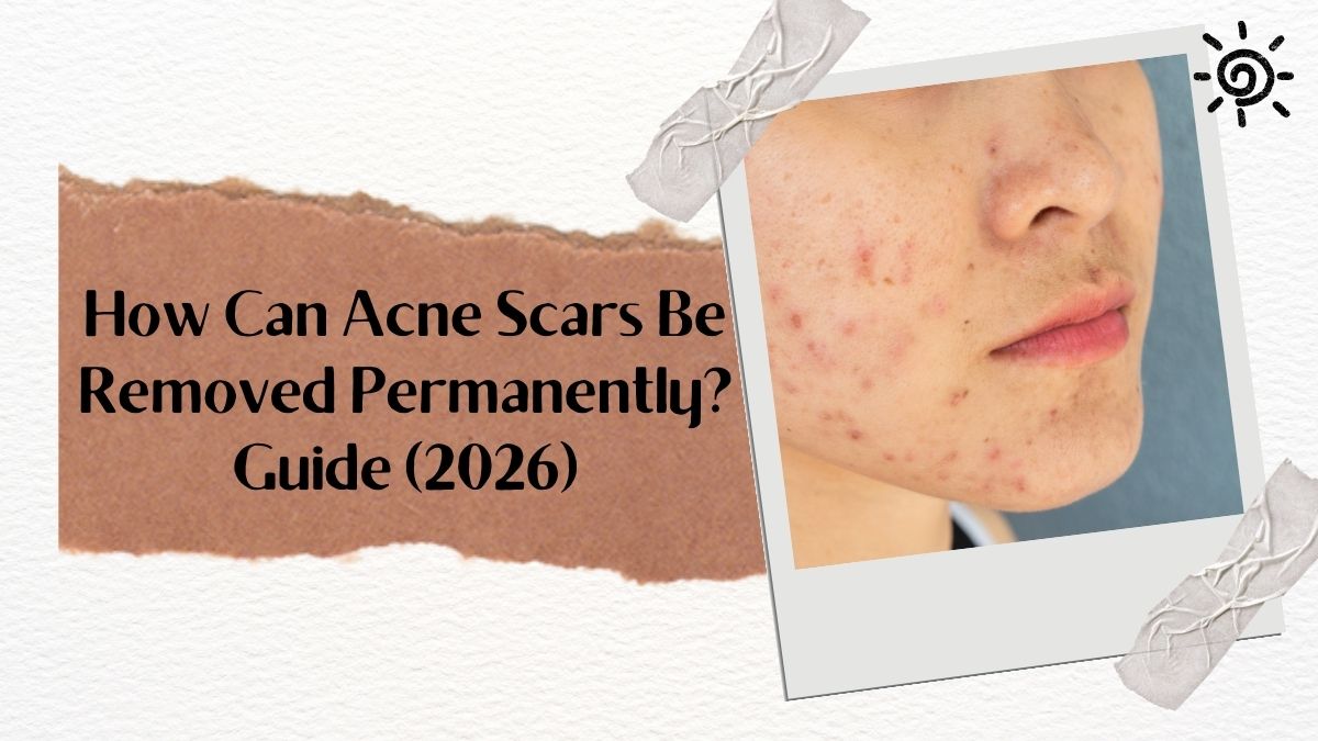 How Can Acne Scars Be Removed Permanently? Guide (2026)