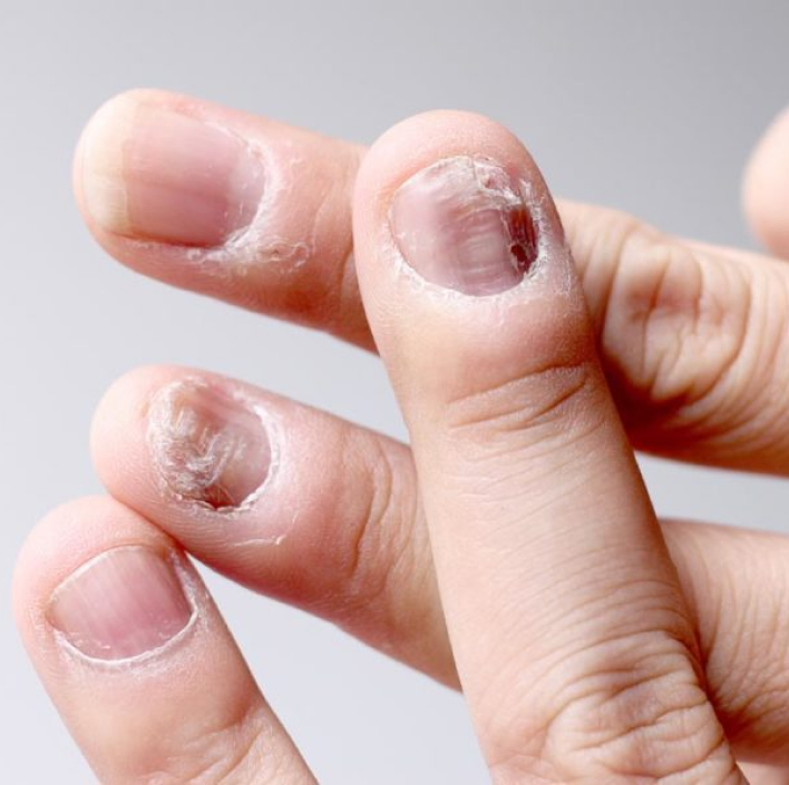 Nail disorders