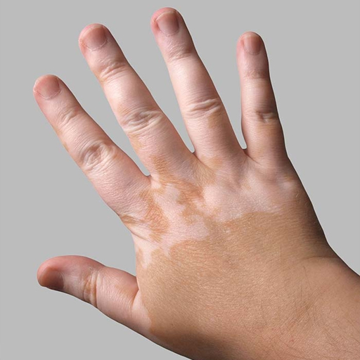 Vitiligo