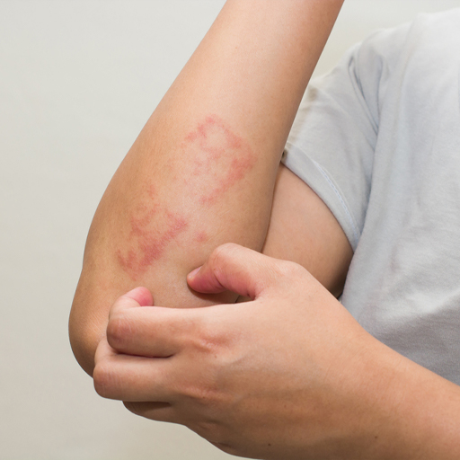 Skin Allergy