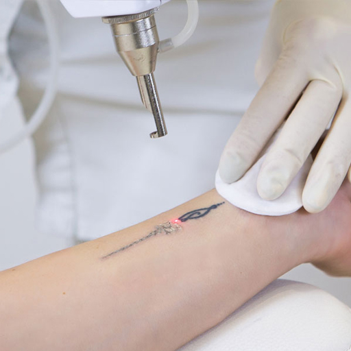 Tattoo Removal