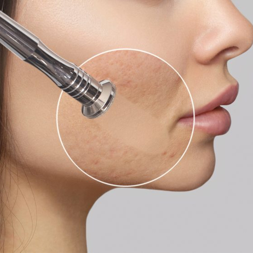 Microdermabrasion