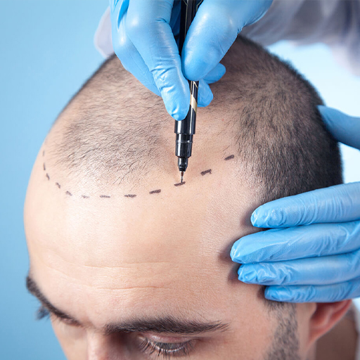 Hair Transplant