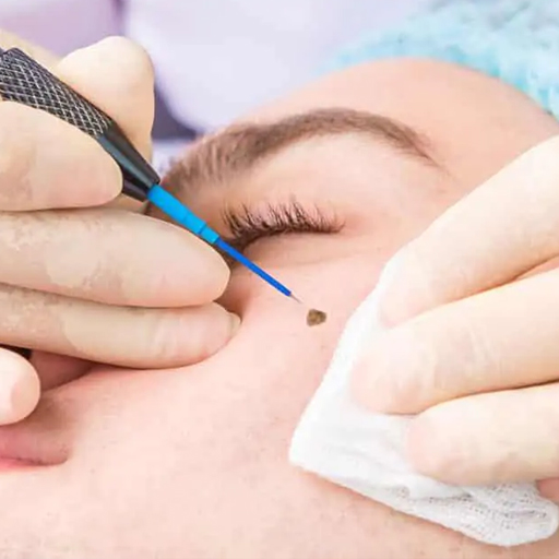 Mole, Warts & Skin tags removal